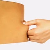 Soğuk Lipoliz Sonrası Nelere Dikkat Edilmeli? Bakım Rehberi